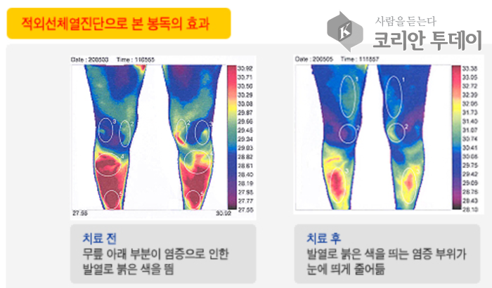 [벌침요법_09] 벌침요법의 항염 효과: 염증을 줄이는 자연 요법