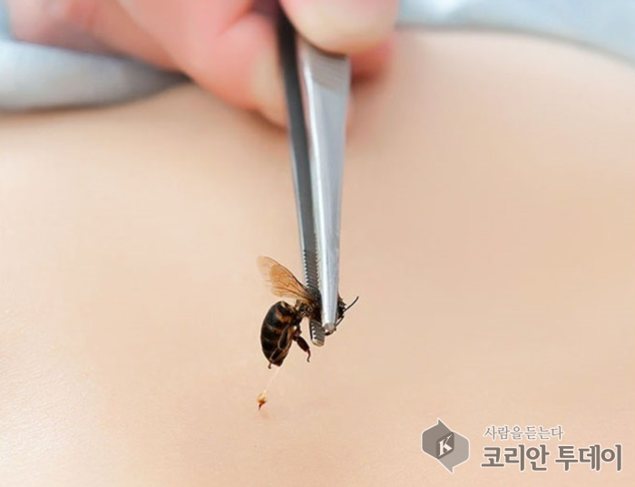 [벌침요법_07] 벌침요법과 면역력: 자연이 선물한 면역 회복의 열쇠